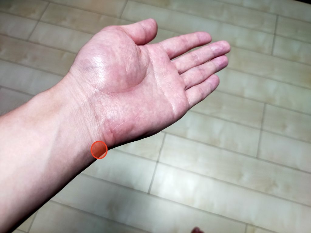 動悸を抑えるツボの神門(しんもん)